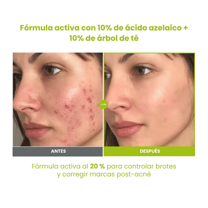 Azelaic Acid 10 Kojic Tea Tree Serum 30ml